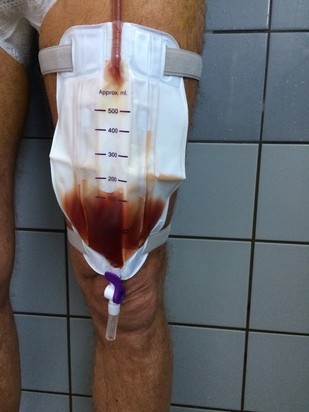 Urinpose med blod i urinen